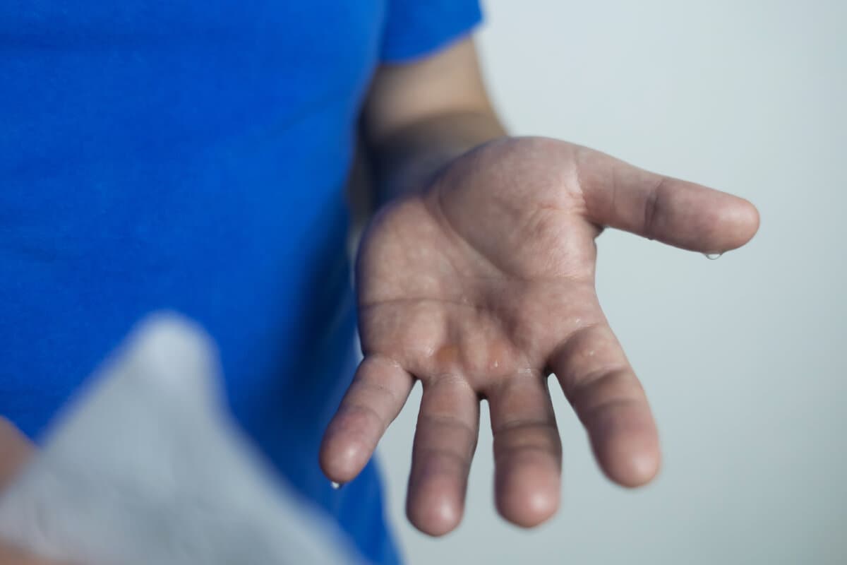 Schwitzende Hände (palmare Hyperhidrose)
