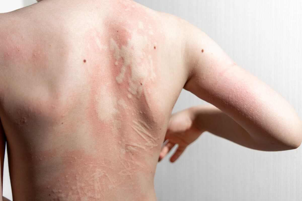 Assoziierte Komorbiditäten bei Dermatosen