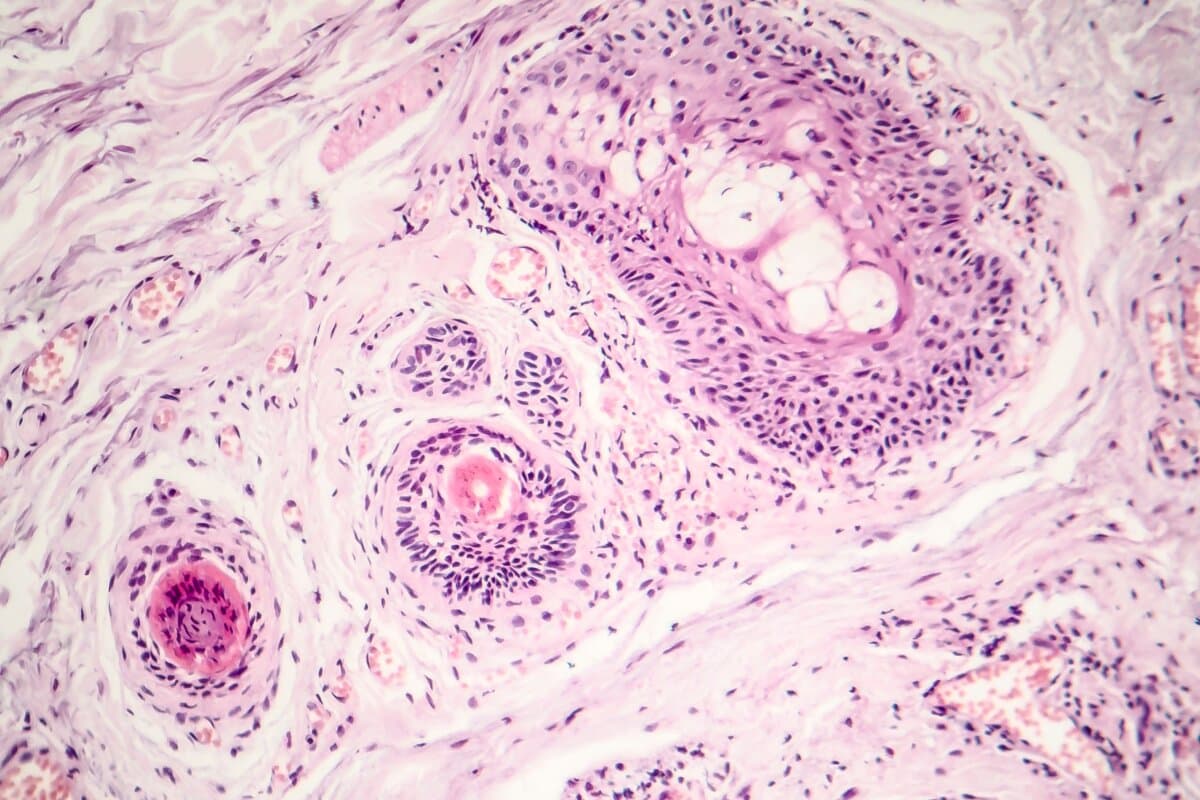 Basal cell carcinoma, skin cancer, light micrograph, photo under microscope