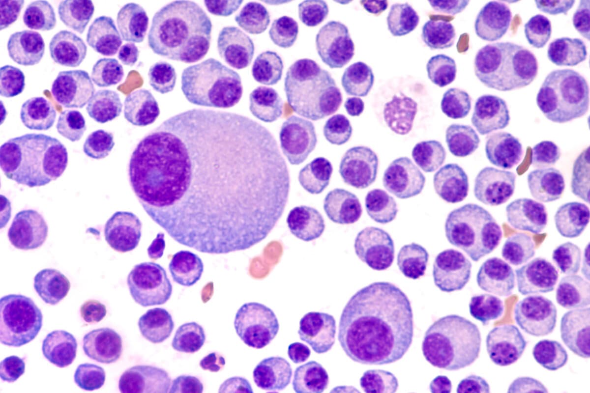 Studie zu Tec-Dara bei Multiplem Myelom