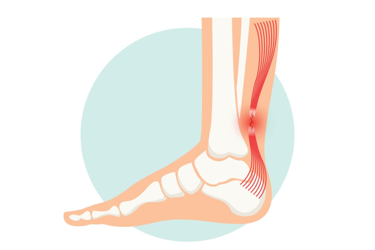 Achillessehnenruptur