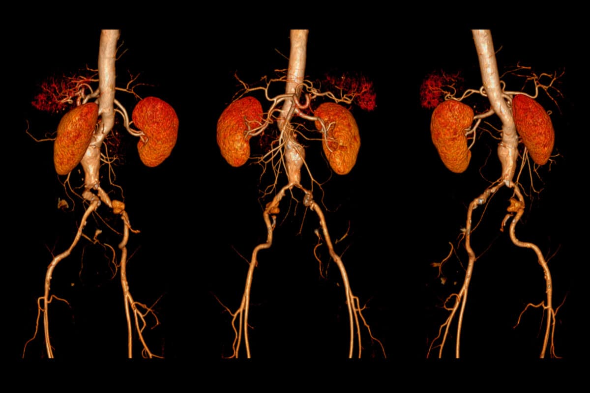Angiologische Erkrankungen sicher erkennen, z.B. Aortenaneurysma