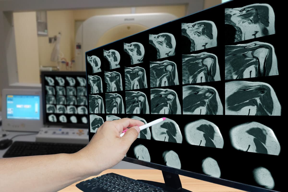 Magnetic resonance imaging of left shoulder rotator cuff tear with suspected lipoma of left shoulder science and education