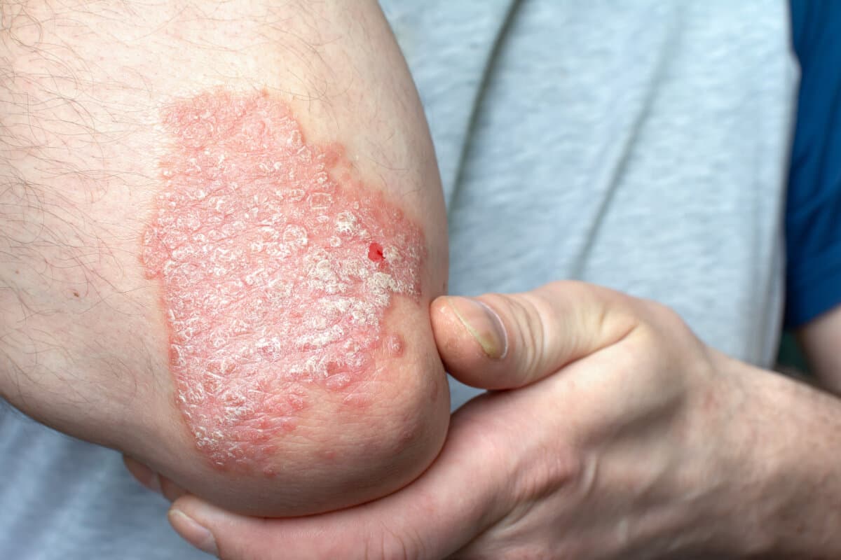 A large spot of psoriasis on the elbow