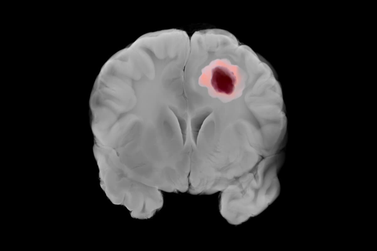 Glioblastoma Tumor Highlight in Left Cerebral Hemisphere Coronal View