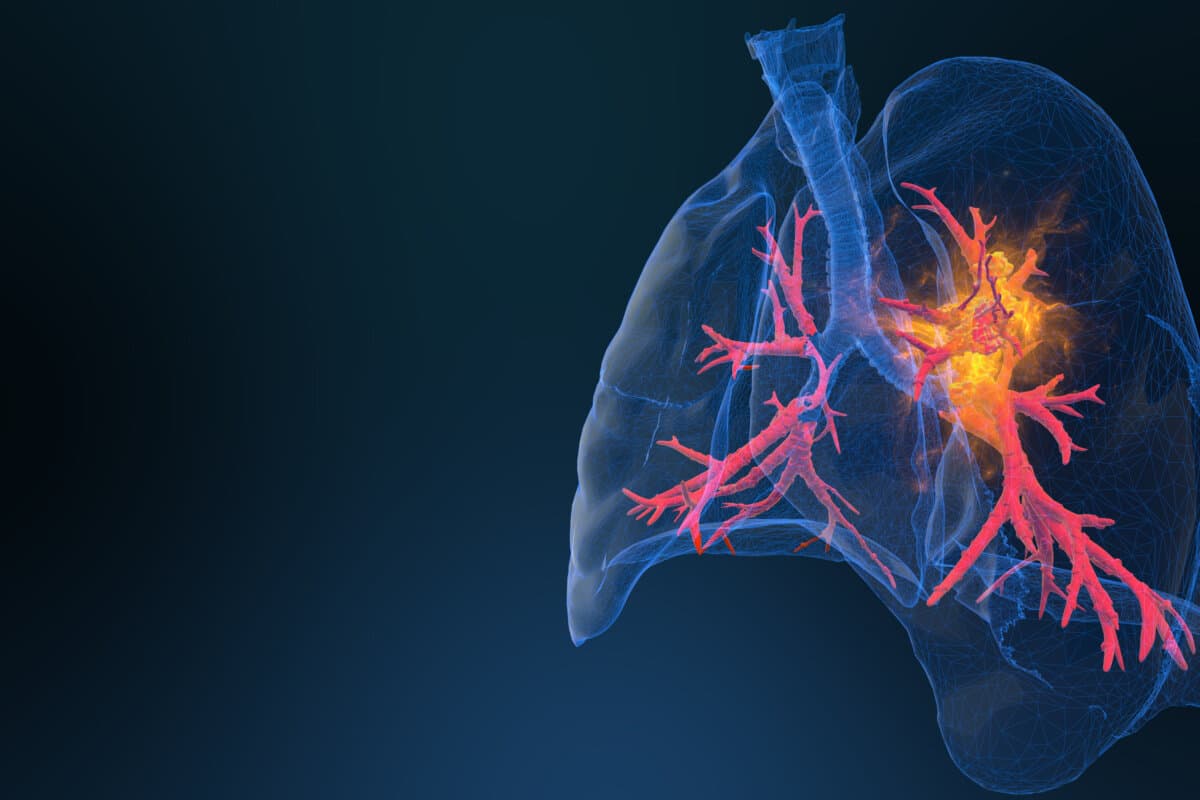 TOP-Studie zu Osimertinib bei NSCLC