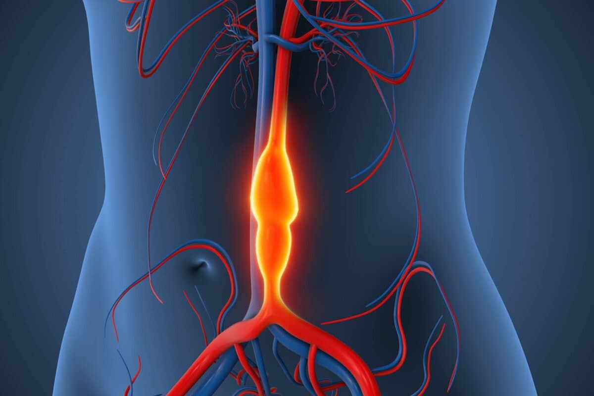 Aortenaneurysma