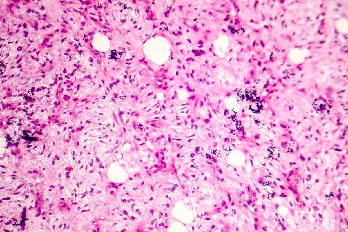 Liposarcoma, soft tissue sarcoma, light micrograph, photo under microscope