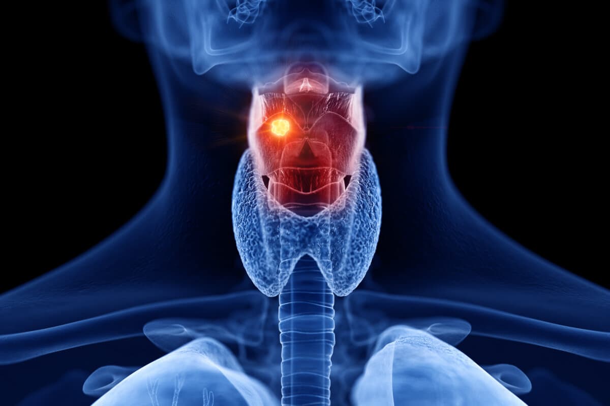 3d rendered medically accurate illustration of larynx cancer