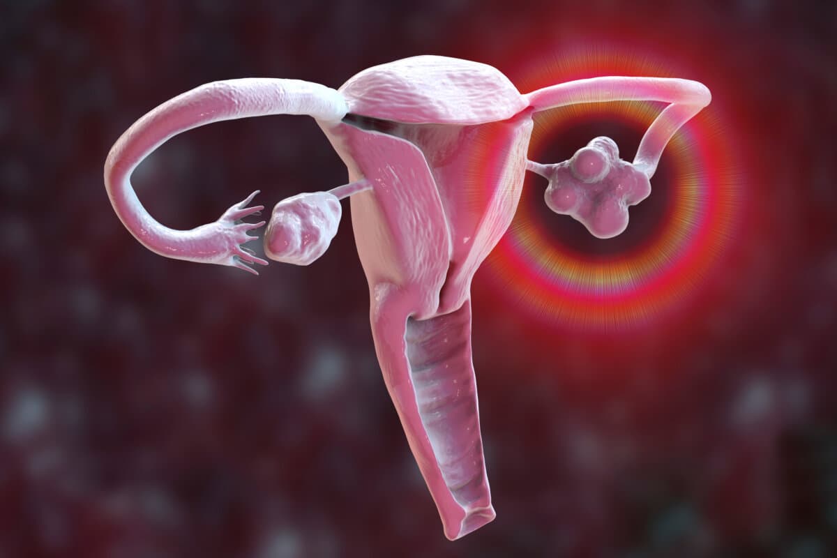 Polycystic ovary syndrome, 3D illustration showing healthy ovary (right) and enlarged ovary with cysts (left)