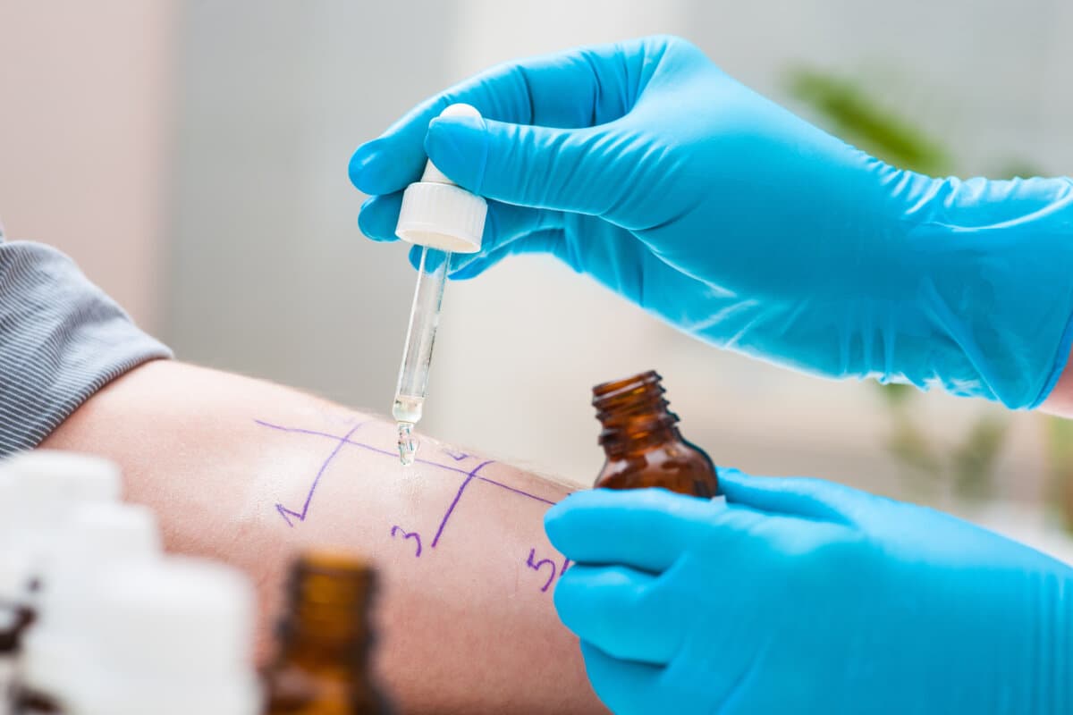 Skin prick allergy test to find out kind of allergy