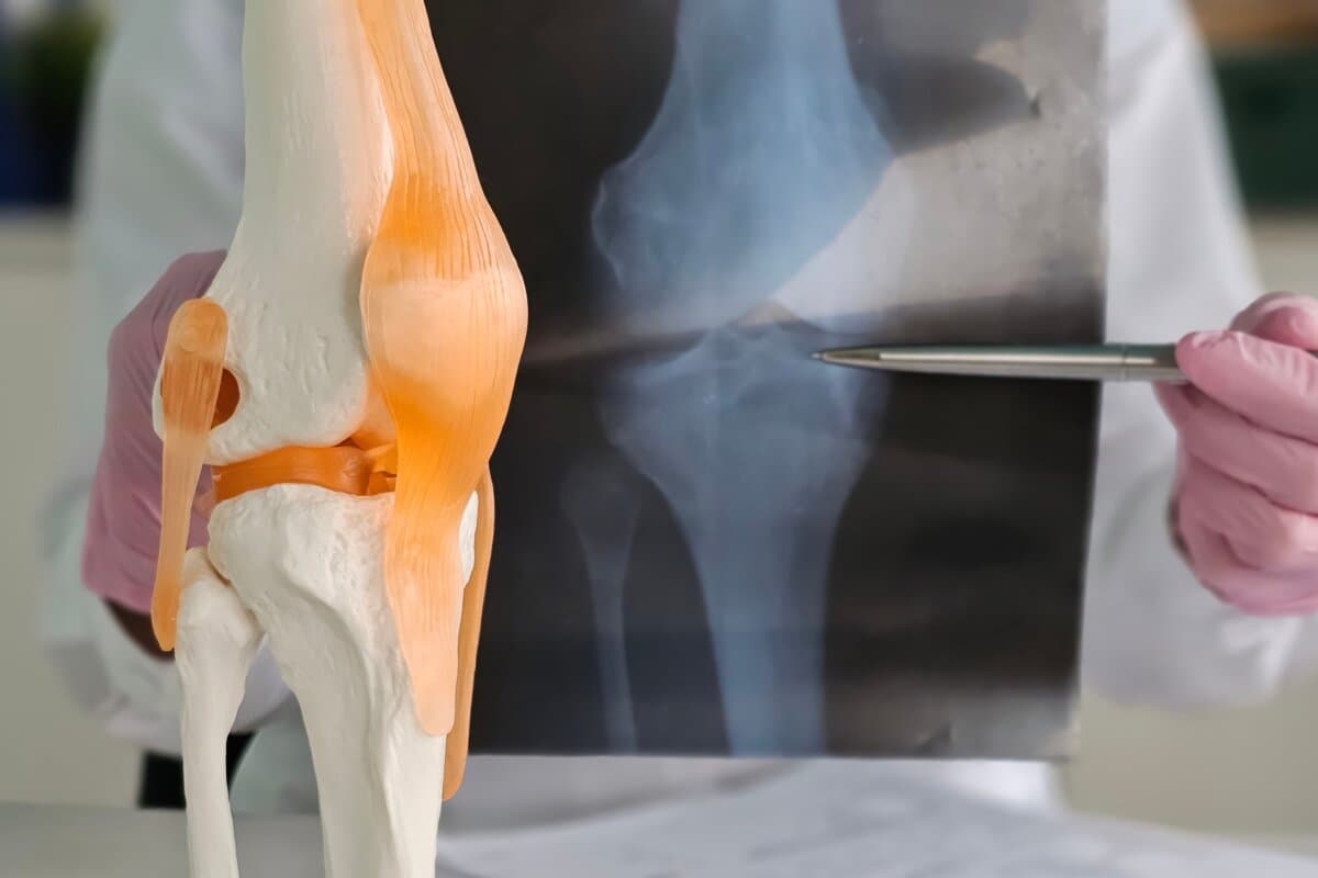 Traumatologist examining x-ray and showing problem on anatomical model of knee closeup.