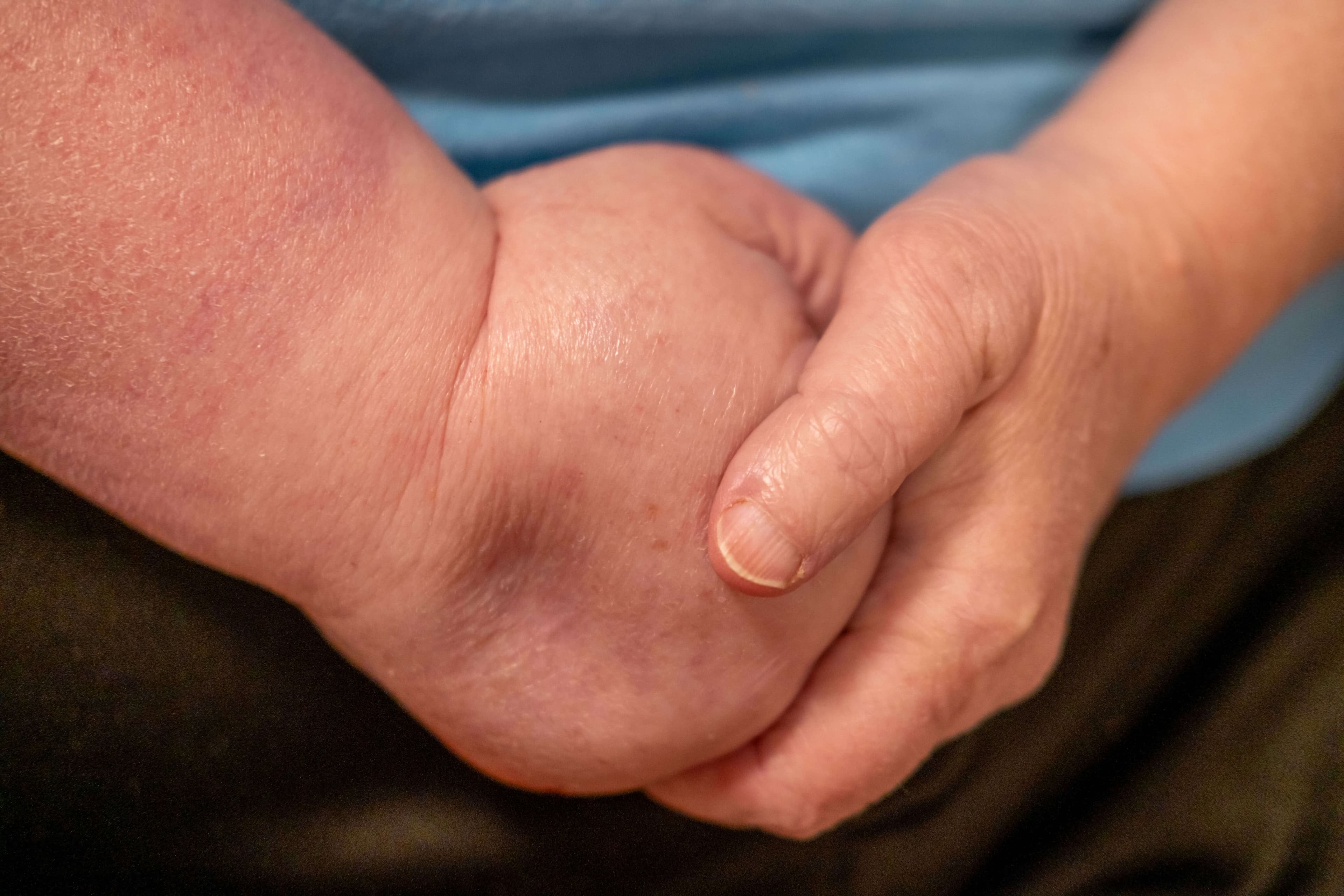 severely swollen paralyzed hand, edema and inflammation, clinical observation lymphatic, vascular disorder, healthcare,