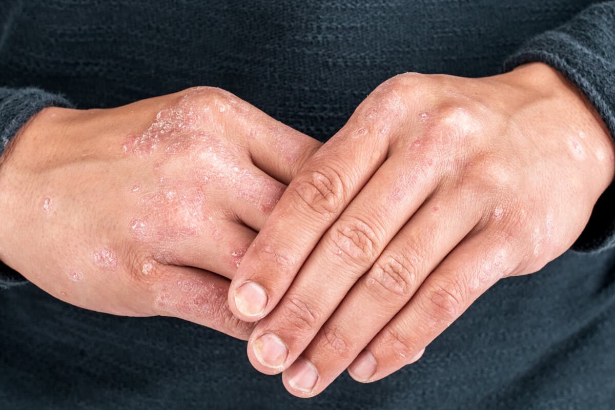 Man with sick hands, dry flaky skin on his hand with vulgar psoriasis, eczema and other skin diseases such as fungus,