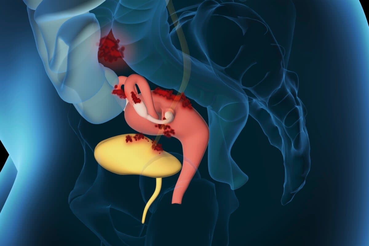 Endometriose