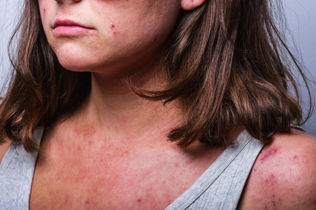 Atopische Dermatitis