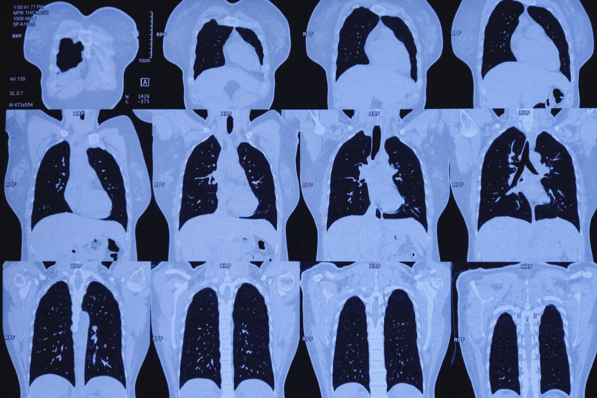 Thorax-HRCT zum ILD-Screening