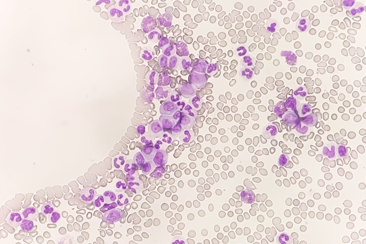 Mikroskopischer Blutausstrich bei chronischer myeloischer Leukämie (CML).