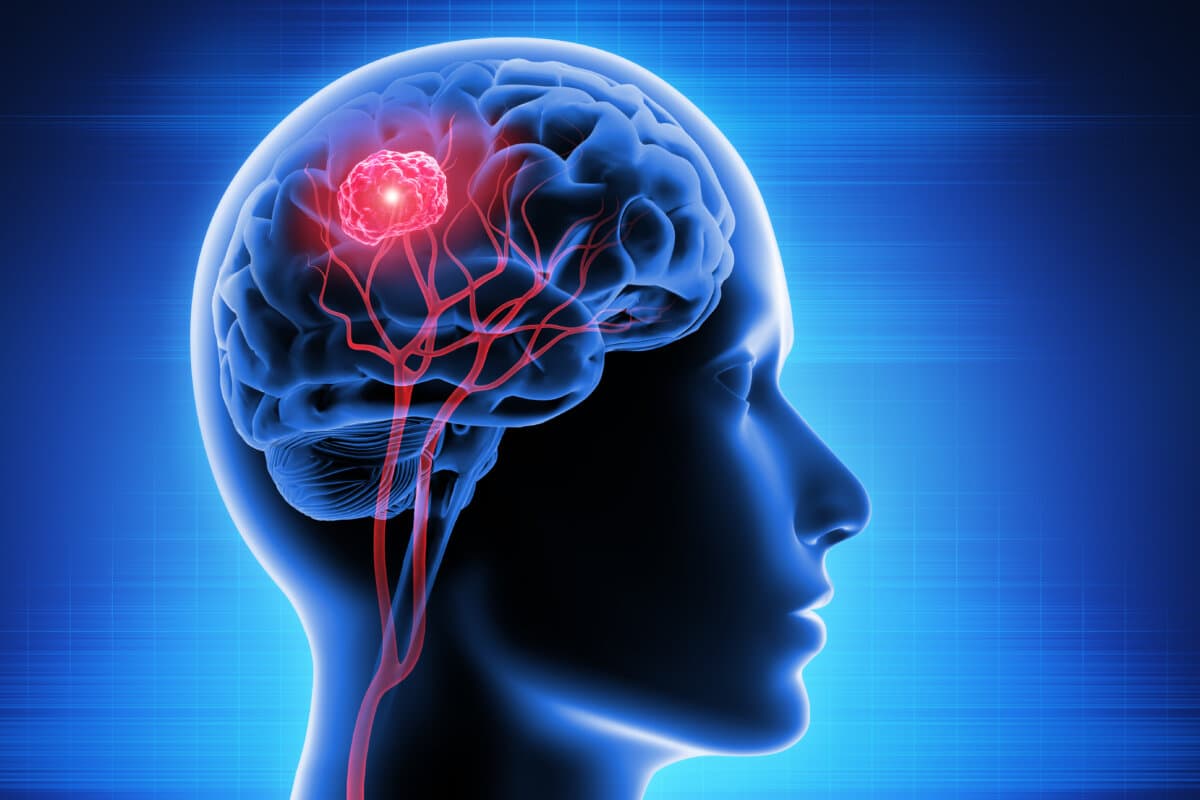 Diagnose Hirn-Tumor