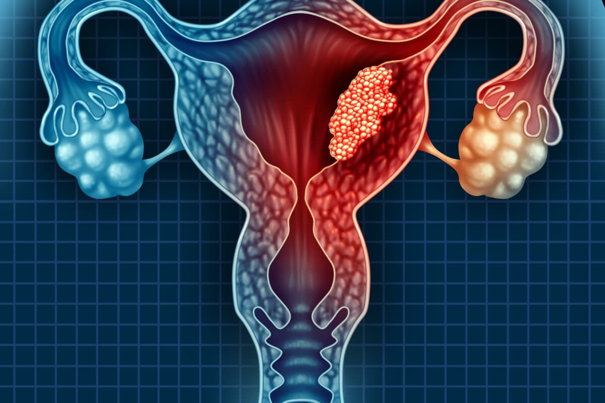 Uterus Cancer