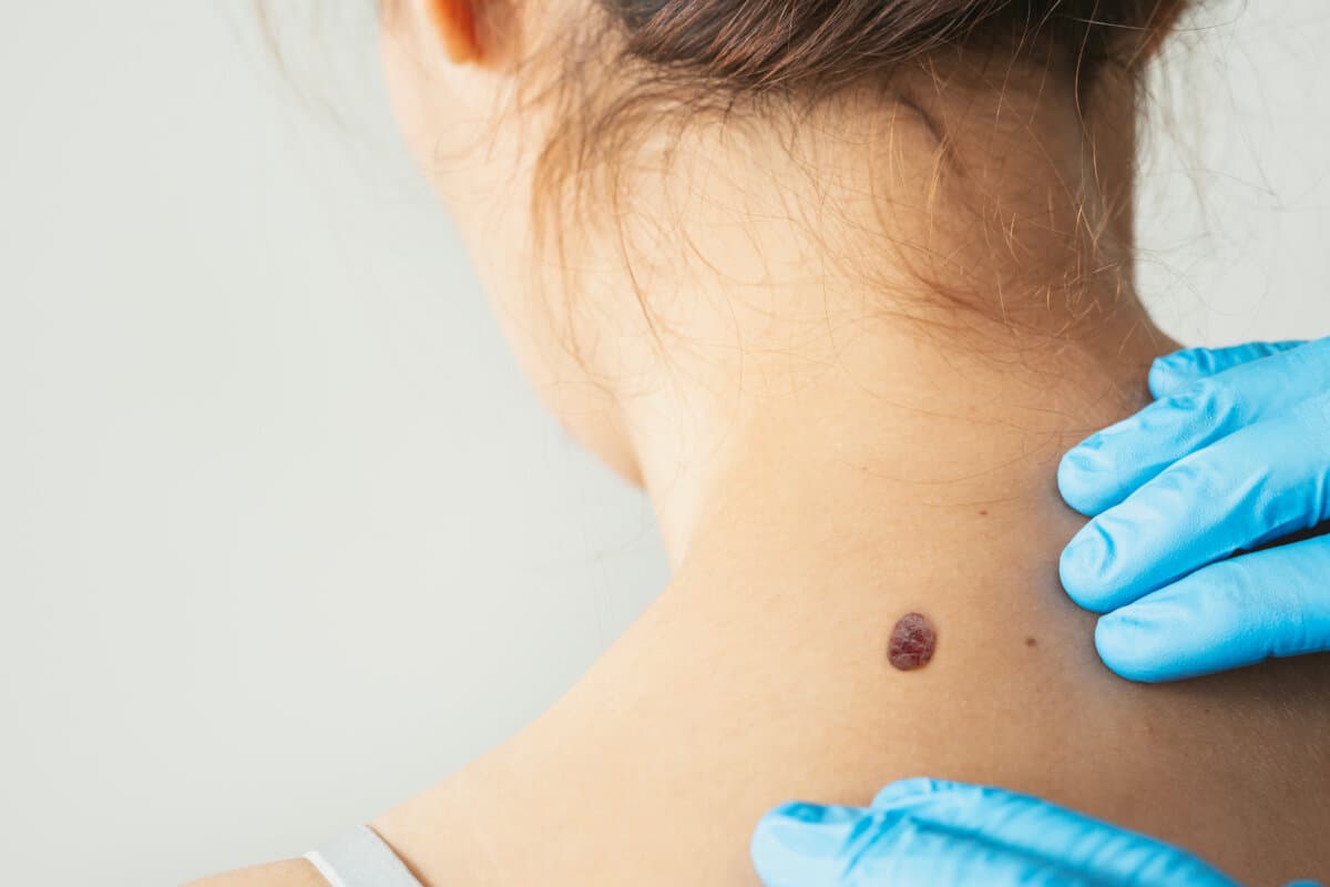 Examining skin for potential cancerous growths