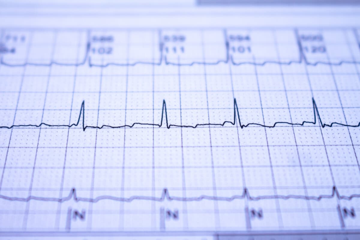 Electrocardiogram with cardiac arrhythmia.