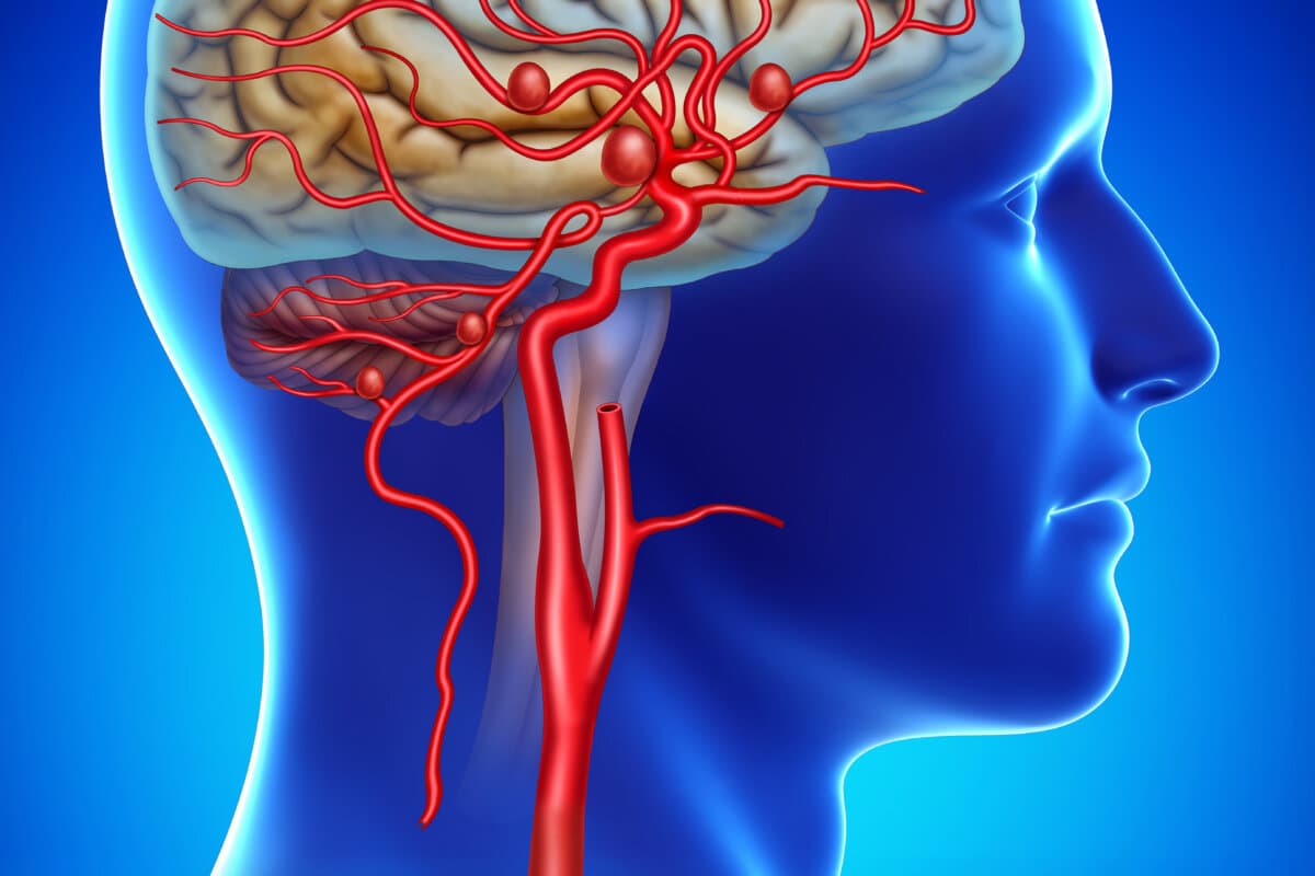 Rendering human head on a blue background with a saccular aneurysm
internal carotid artery