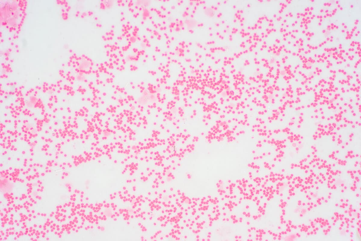 Bone marrow biopsy from myelodysplastic condition under the microscope view. Histology tissue of bone marrow biopsy.