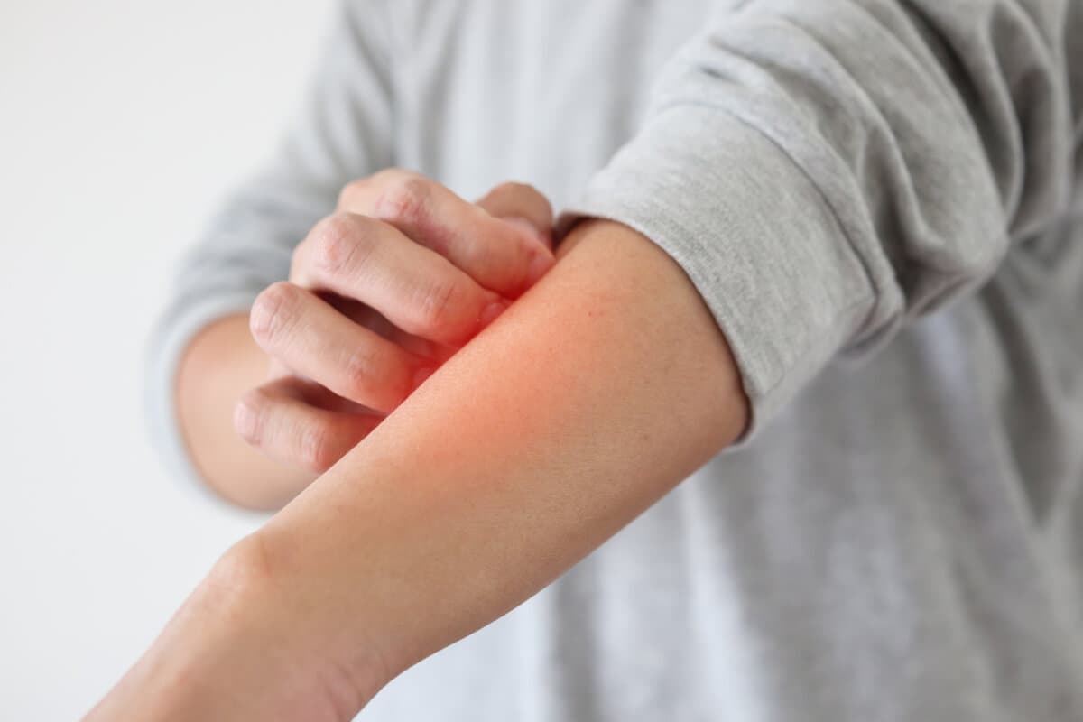 Young asian man itching and scratching on arm from itchy dry skin eczema dermatitis
