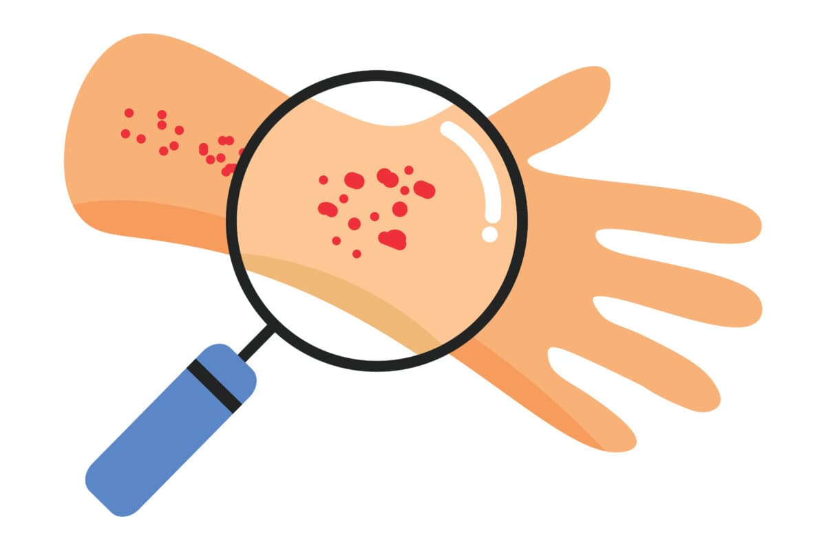 Dermatomyositis