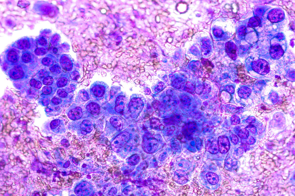 Am WCLC wurden Daten zu Zipalertinib bei NSCLC vorgestellt.