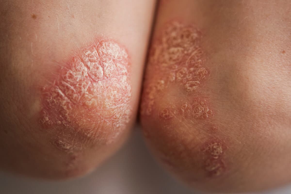 psoriasis on the skin of the elbow of a young woman in a white T-shirt. close-up
