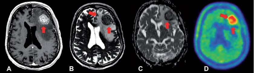 A:In der T1-gewichteten MRT-Sequenz kommt eine rundliche kontrastmittelaufnehmende Läsion links frontal zur Darstellung. Bildgebung eines 81-jährigen Patienten, der nach einem ersten epileptischen Anfall an der Notaufnahme vorstellig wurde.  
B: In der T2-gewichteten Aufnahme wird vor allem das peritumorale Ödem besser abgebildet. 
C: Eine diffusionsgewichtete MRT-Sequenz präsentiert einen zellreichen Tumor (dunkel) mit zellarmen Anteilen (hell, Ödem).  
D: Die 18F-FET-PET zeigt einen verstärkten Tumormetabolismus in der kontrastmittelaufnehmenden Läsion im MRT. Der Patient unterzog sich in weiterer Folge einer operativen Entfernung der Raumforderung, und es fand sich histologisch ein Plattenepithelkarzinom als zerebrale Metastase eines bis dahin noch nicht diagnostizierten Karzinoms der Speiseröhre. 
