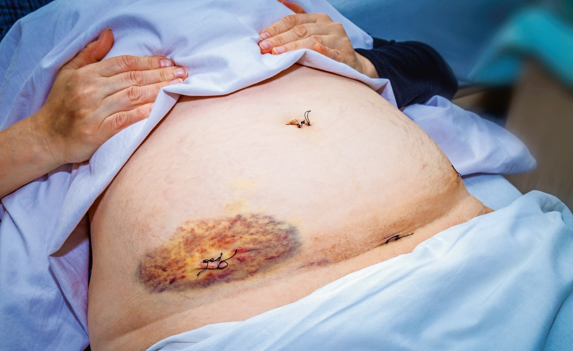 Bei kutanen und subkutanen Endometrioseläsionen reicht laut Imboden und Mueller meist eine operative Entfernung als Therapie.