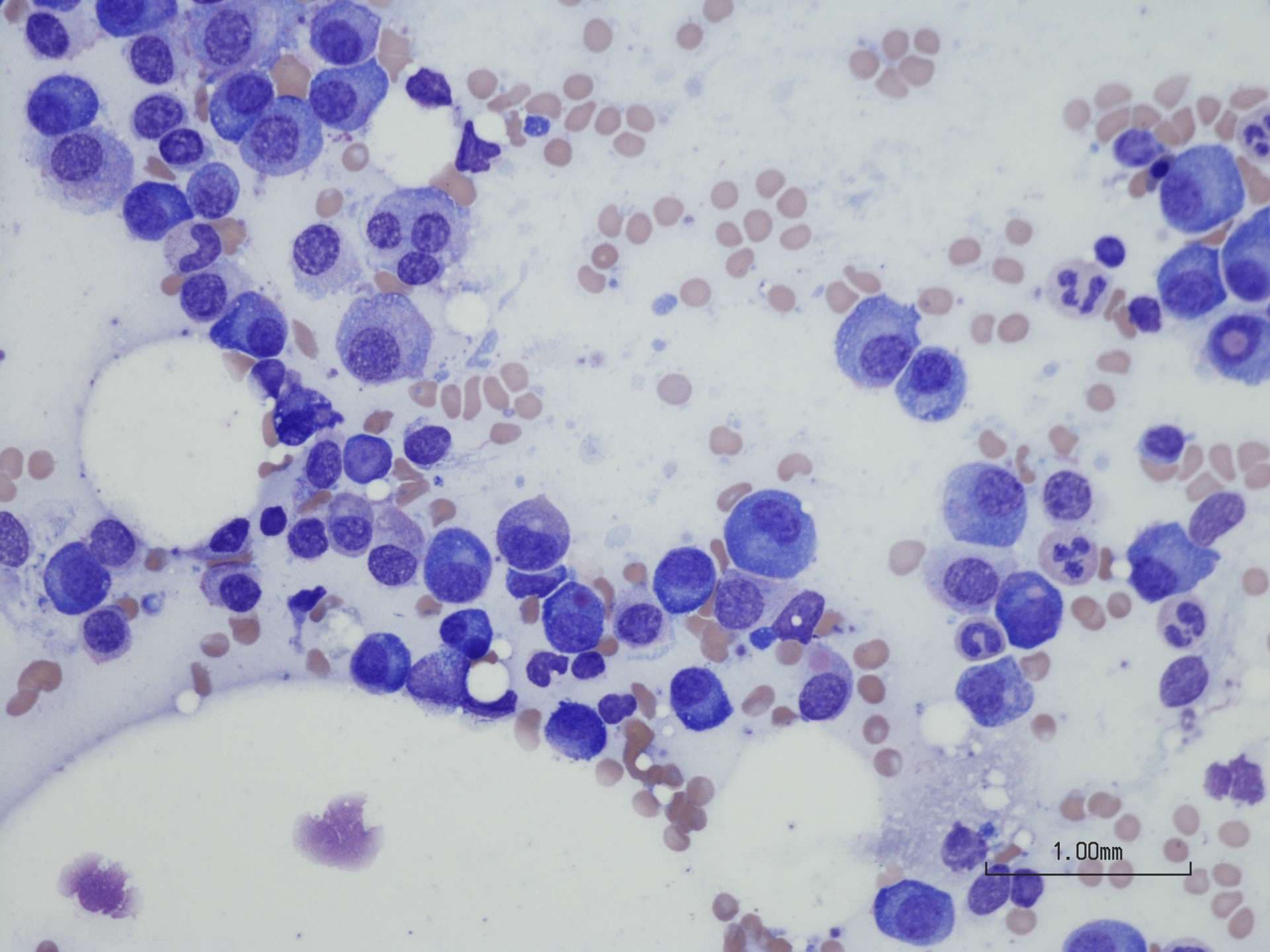 Plasmazellmyelom aus Knochenmarkaspirat.