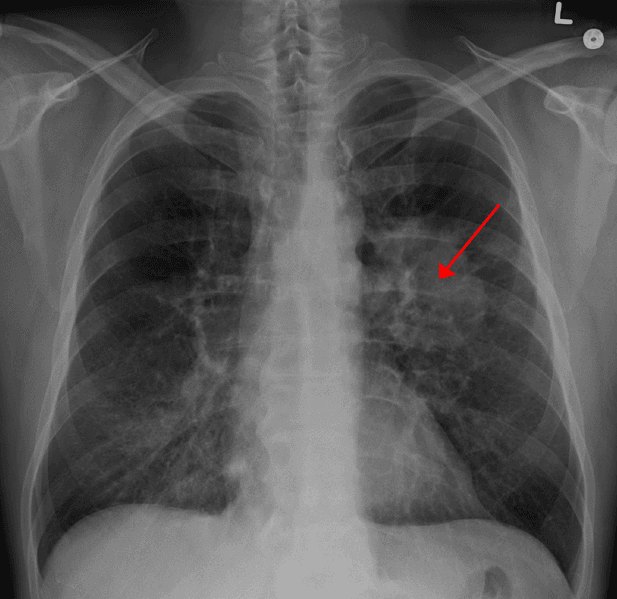 Für die Behandlung des NSCLC sind bereits zwei PD-1-Antikörper zugelassen