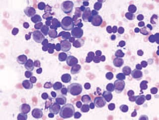 18549-DFP_Multiples_Myelom