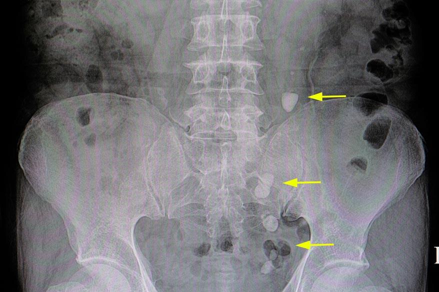 Röntgenbild eines Patienten mit Nierensteine