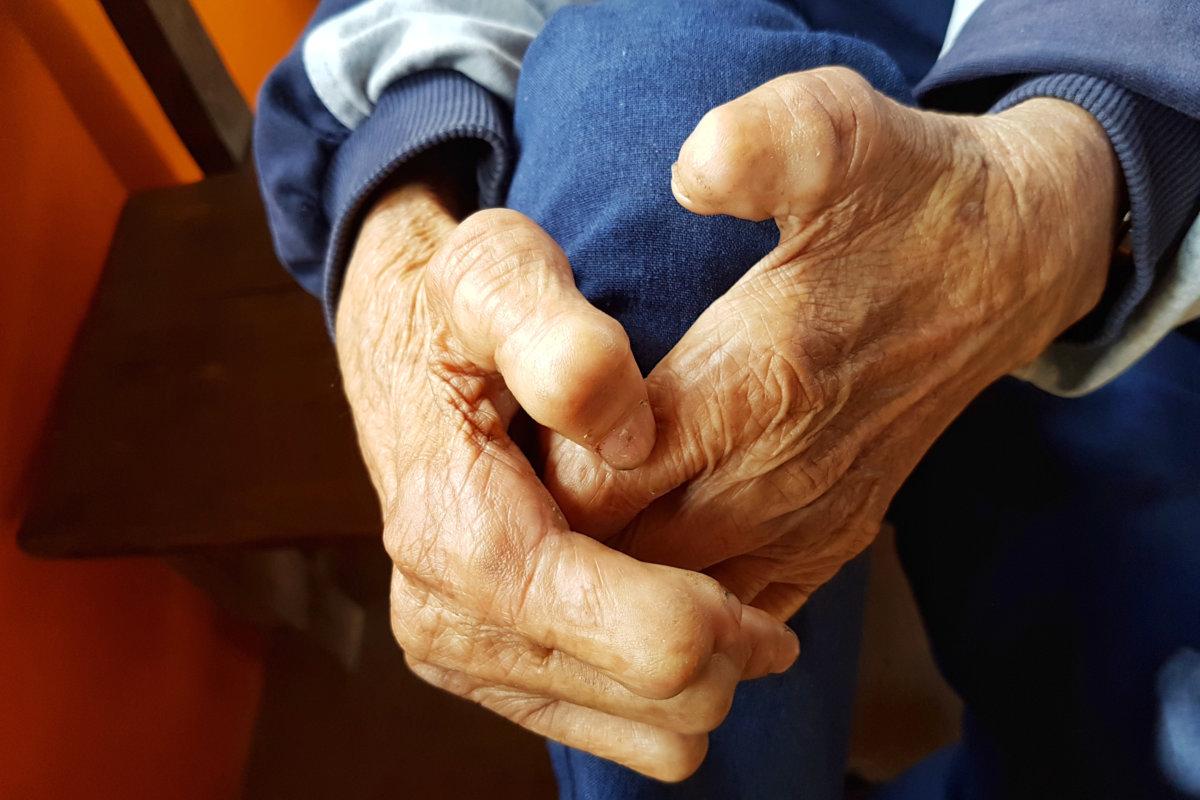 closeup hands of asian old man suffering from leprosy, Thailand