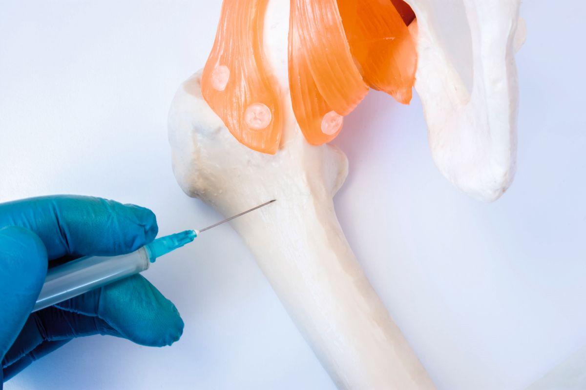 Knochenmarkuntersuchungsverfahren: Biopsie, Aspiration oder Parazentese-Konzeptfoto. Der Arzt hält die Handschuhspritzennadel und das Punktionsmodell des Hüftknochens in der Hand, um die Analyse des Knochenmarks durchzuführen