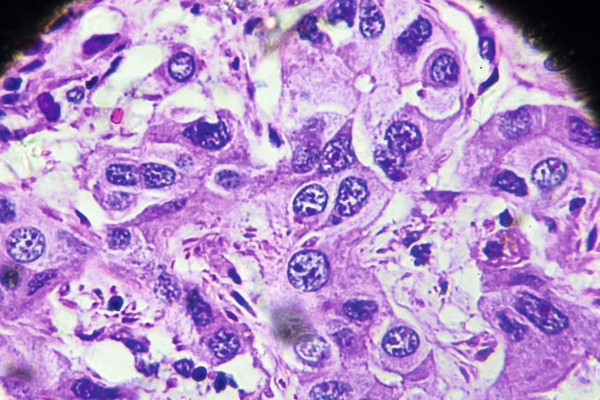 Hepatozelluläres Karzinom, HCC unter dem Mikroskop