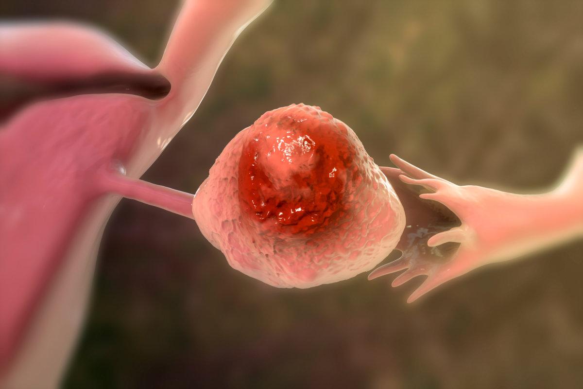 Ovarian cancer, 3D illustration showing malignant tumor in the left ovary