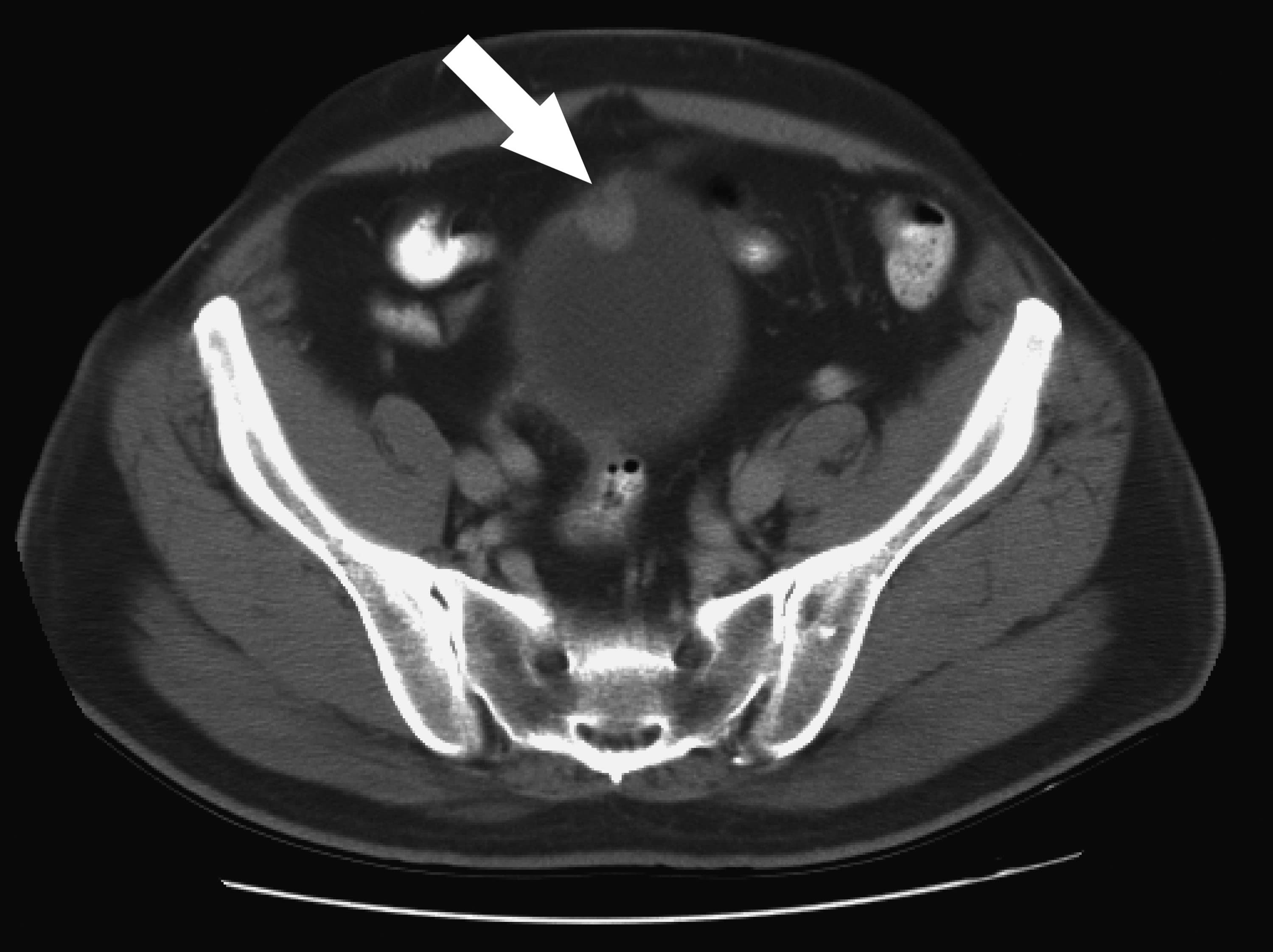 Bladder Cancer_c_NCI_Dr Peter Choyke Molecular Imaging Programjpg