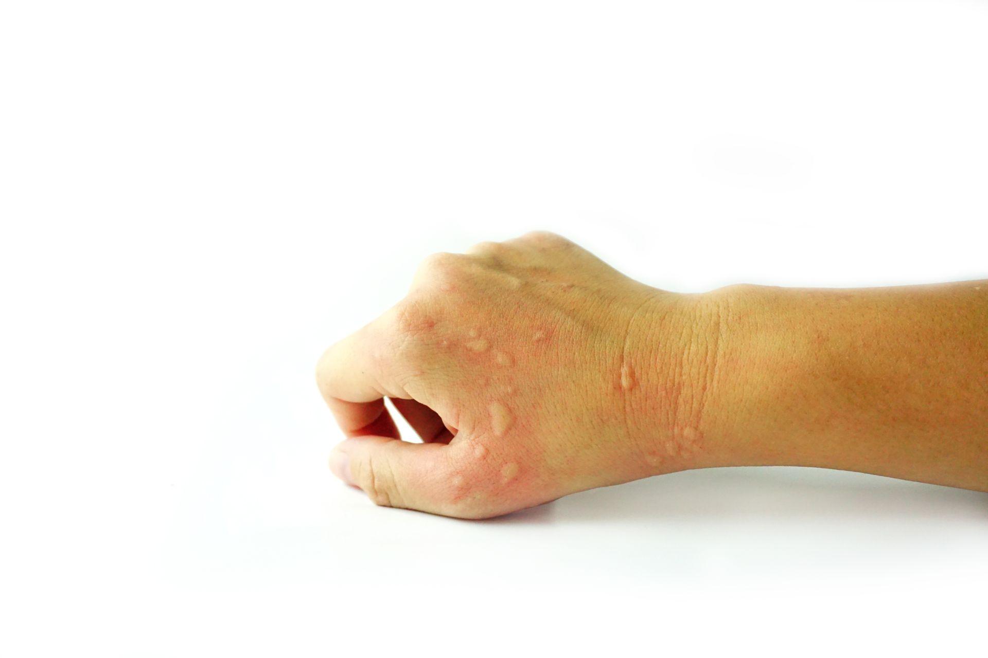 Dermatitis Problem von Hautausschlag, Allergie Hautausschlag und Gesundheitsproblem auf Arm weißen Hintergrund