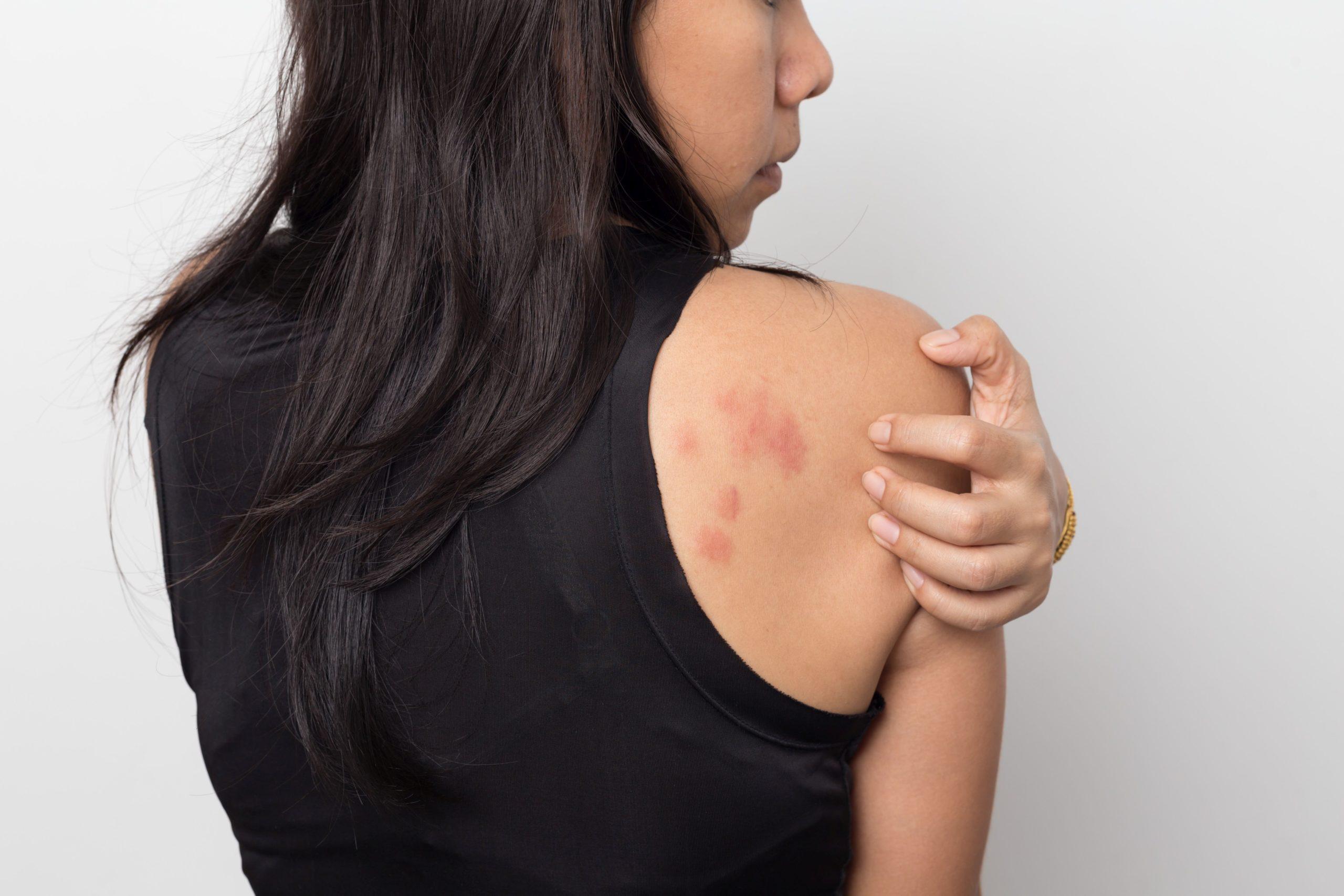 Frau zeigt ihre Haut hinterher juckend, mit Allergie Hautausschlag Urtikaria Symptome