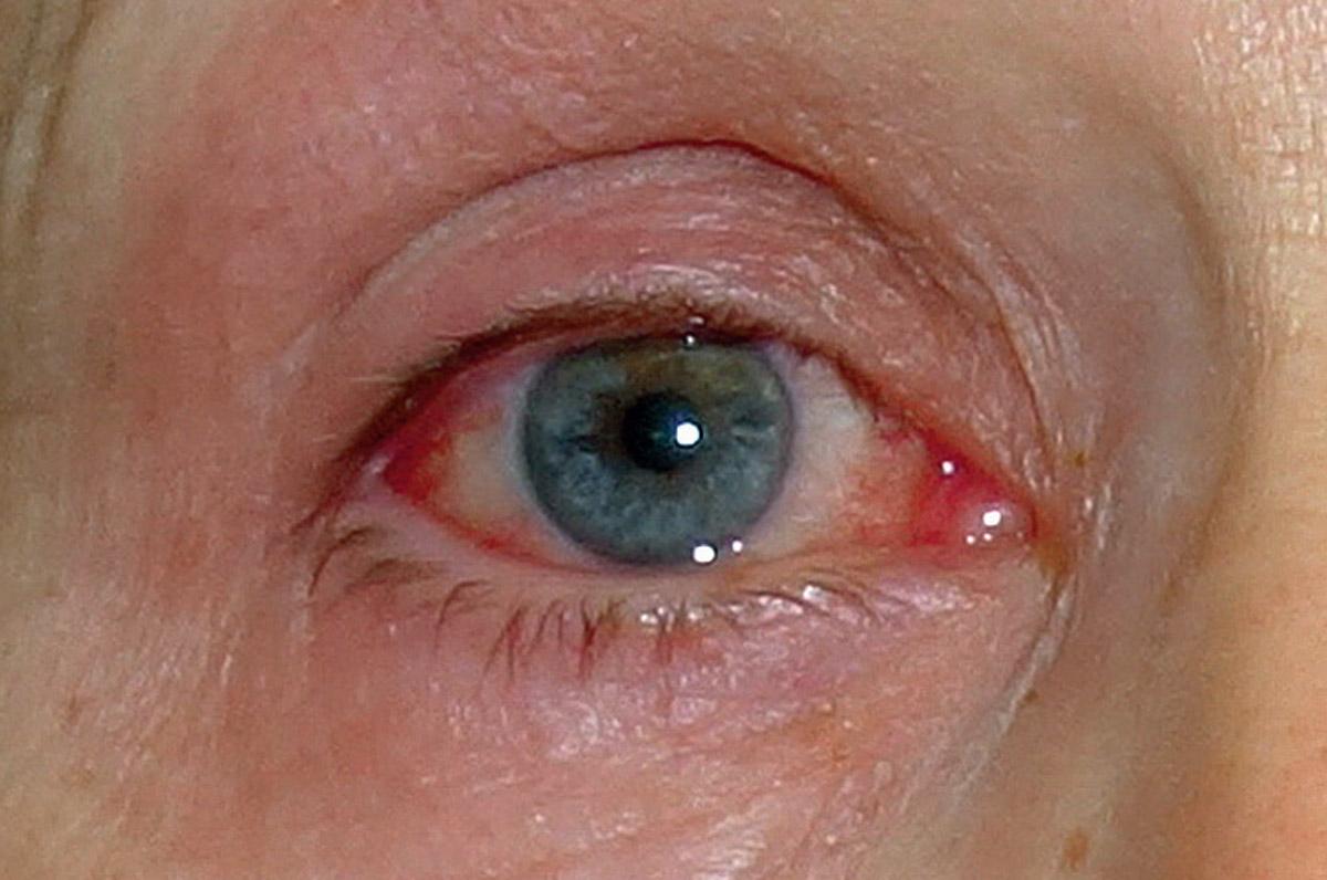 Augenentzündungen bei COVID-19