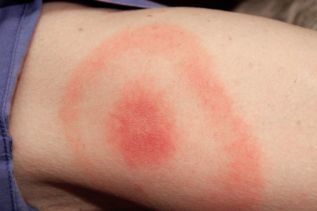 Die Wanderröte ist ein fast sicheres Zeichen für eine Borreliose-Infektion.