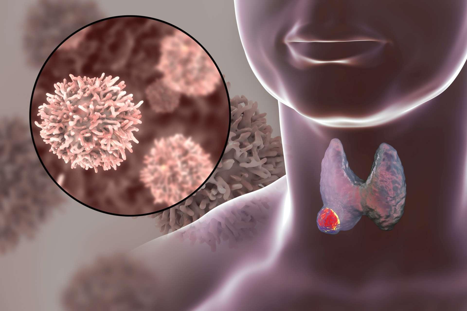 Schilddrüsenkrebs. 3D-Illustration, die Schilddrüse mit Tumor innerhalb des menschlichen Körpers und Nahaufnahme von Schilddrüsenkrebszellen zeigt