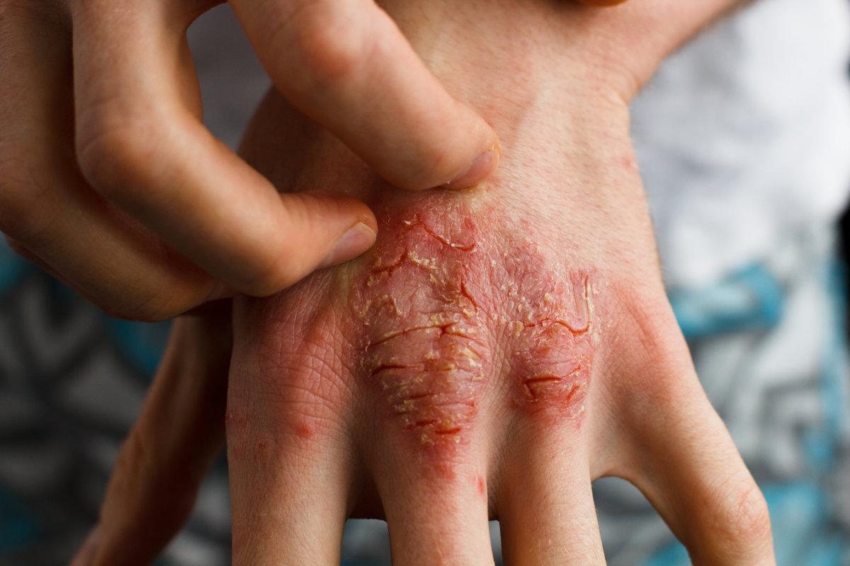 psoriasis, eczema and other dry skin conditions