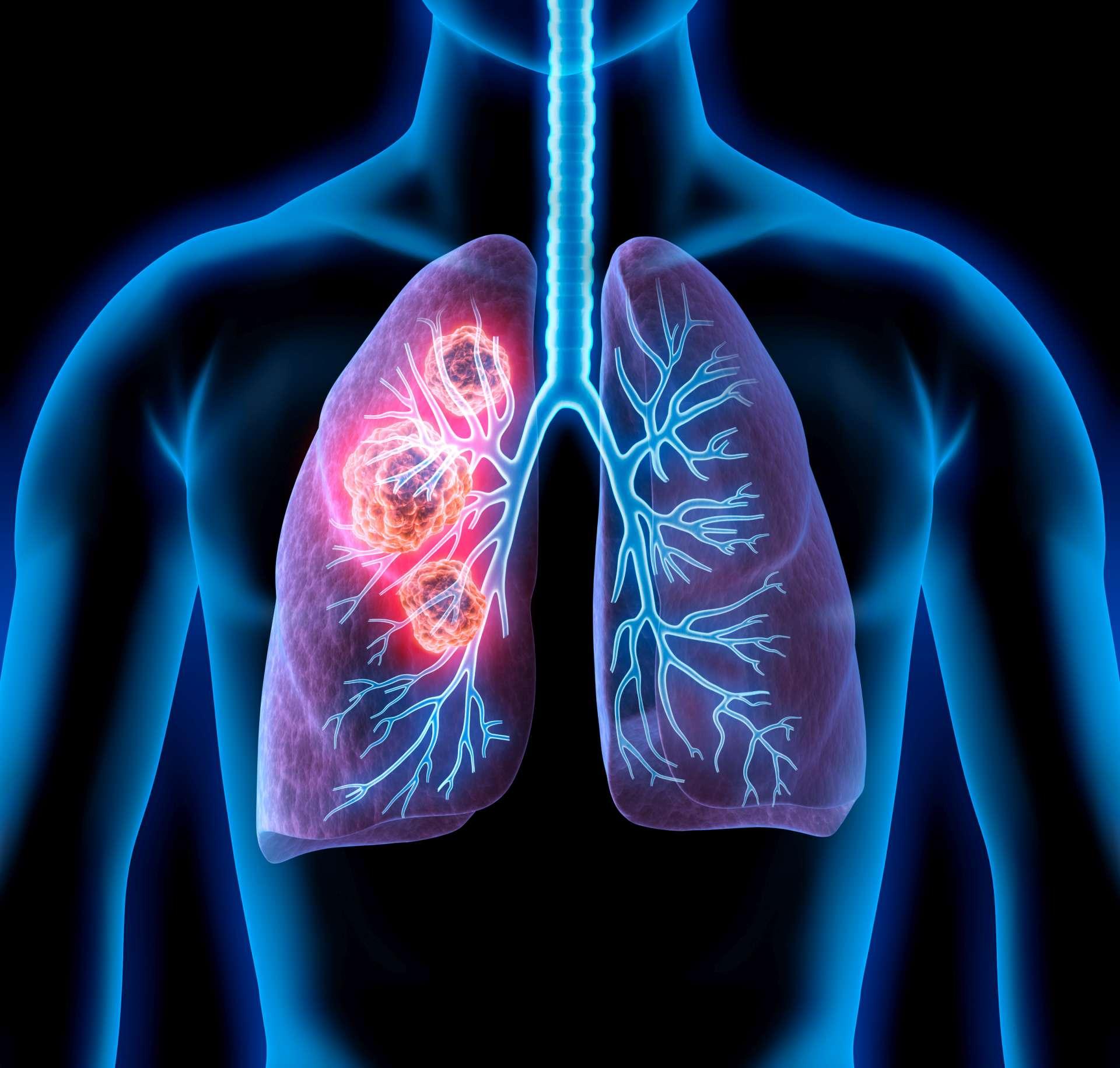 Medizinische Illustration von Lungenkrebs - Krebsgebiet in der Lunge